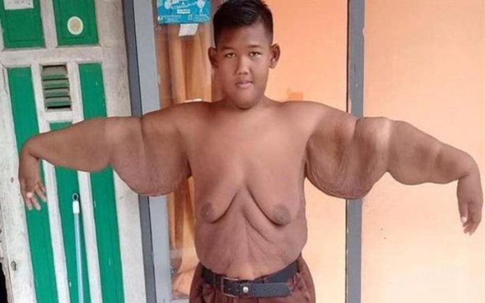 Criança “mais gorda do mundo” está irreconhecível!