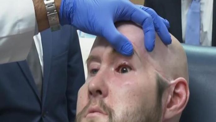 Americano recebe primeiro transplante total de olho e parcial de rosto