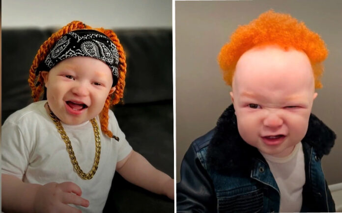 Pais negros dão à luz bebê albino com cabelo ruivo na Turquia Pais negros dão à luz bebê albino com cabelo ruivo na Turquia