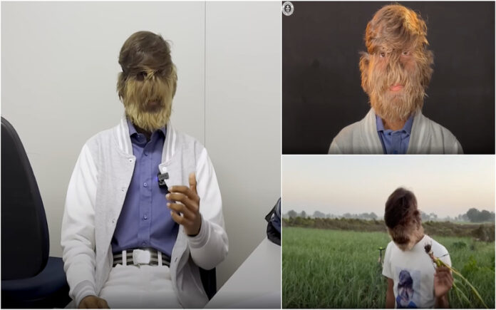 Adolescente com síndrome rara entra para o Guinness pelo rosto mais peludo